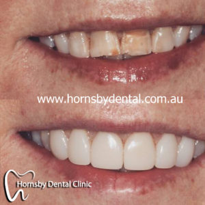 We are the best dentistry in Hornsby for dental veneers.