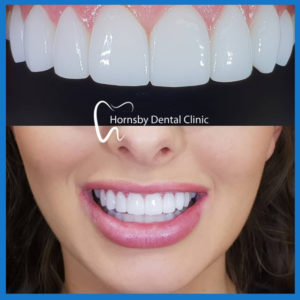 Best porcelain veneers in Hornsby