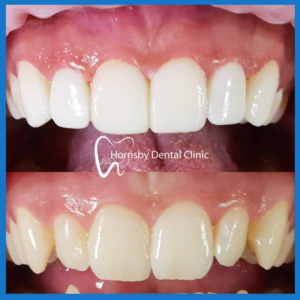 Affordable veneers in Hornsby