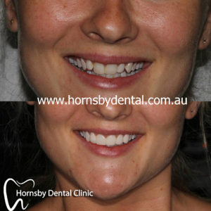 We are the best in Teeth Whitening here in Hornsby.