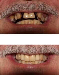 The best dentistry for dental implants in Hornsby.