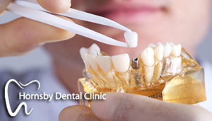 We have the best offer for dental implants in Hornsby.