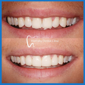 Affordable dental veneers in Hornsby