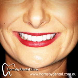 We are the best in Teeth Whitening here in Hornsby.