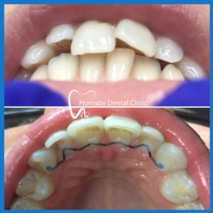 Invisalign in Hornsby