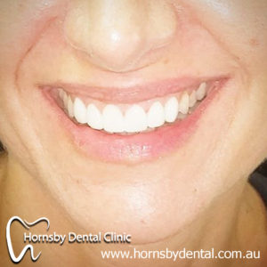 We are the experts of Invisalign here in Hornsby.