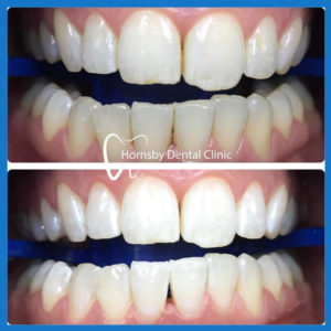 Best teeth whitening in Hornsby