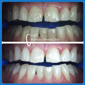 Teeth Whitening in Hornsby