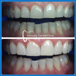 Affordable teeth whitening in Hornsby