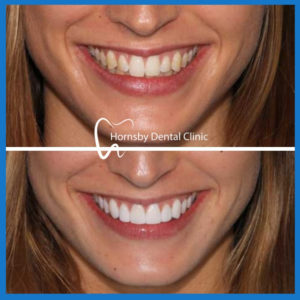 Dental veneers in Hornsby