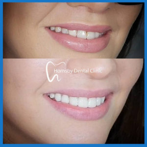 Veneers in Hornsby