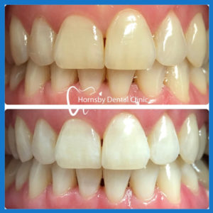 Teeth Whitening in Hornsby