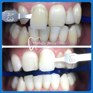 Best dentist for teeth whitening in Hornsby