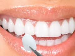 We are the best dentistry for dental veneers in Hornsby.