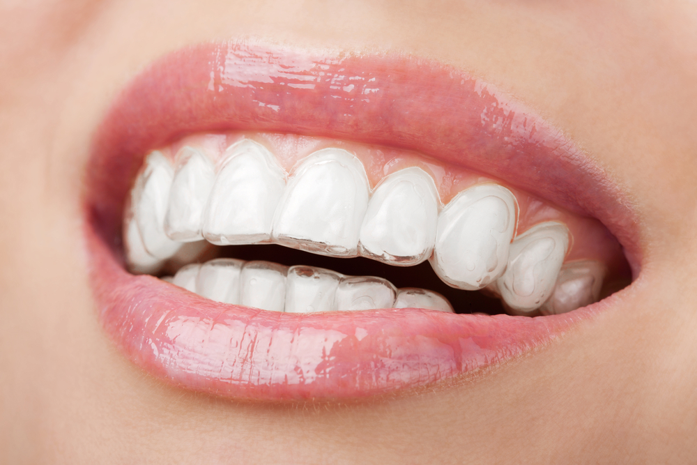We are the best Invisalign provider in Hornsby,