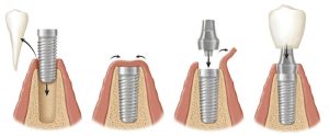 We are the best when it comes to dental implants here in Hornsby.