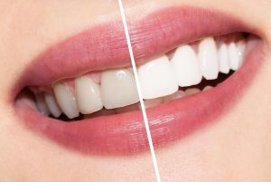 We are the best dentistry for teeth whitening in Hornsby.