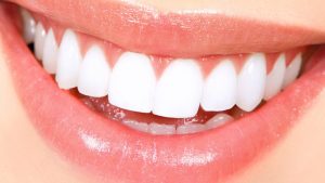 Tooth whitening Hornsby