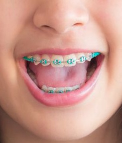 why some kids need braces