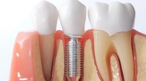 Dental implant surgery available at our clinic in Hornsby.