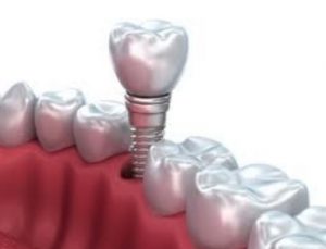 We provide dental implant surgery here in Hornsby.