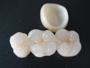 Porcelain crowns cost