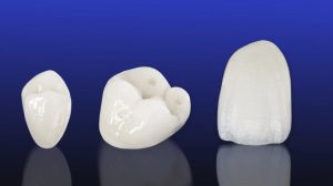 Porcelain crown cost is affordable here in our Hornsby dental clinic.