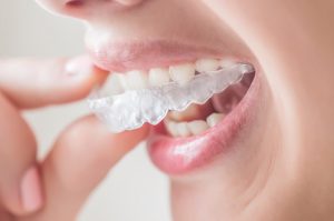 We offer affordable Invisalign in our Hornsby clinic.