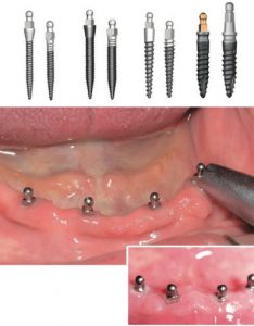 Mini dental implants in Hornsby