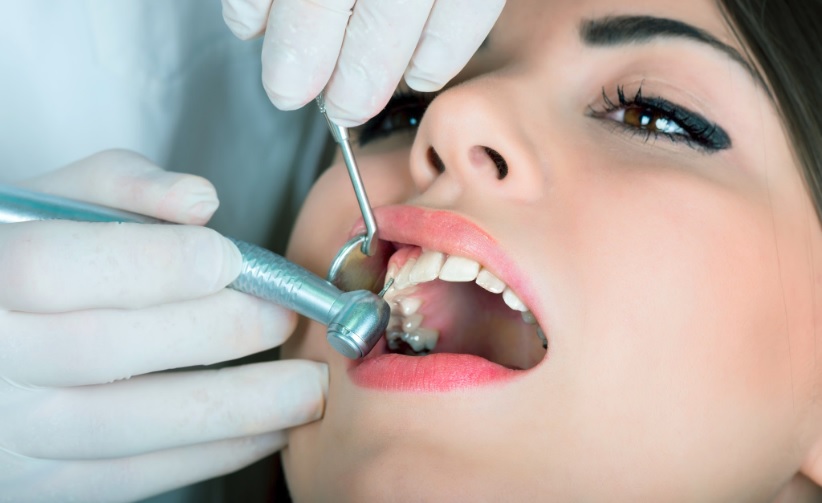 Dental Fillings in Hornsby