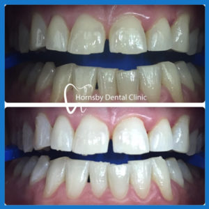 Teeth whitening in Hornsby