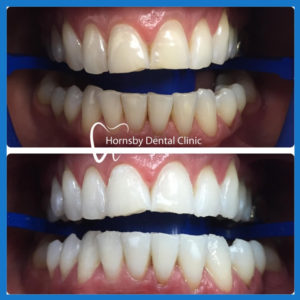 Teeth Whitening in Hornsby