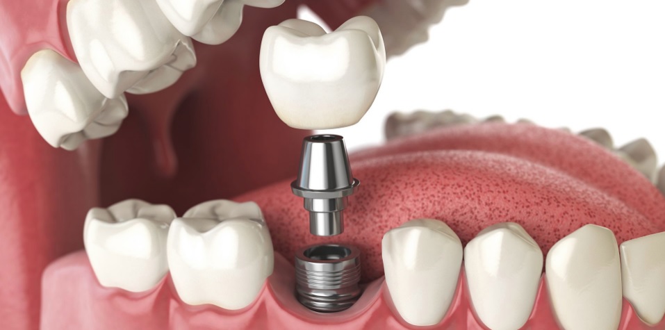 Dental implant cost in Hornsby