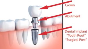 Dental implant cost in Hornsby