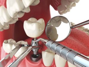 Dental Implant in Hornsby