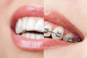 Orthodontics in Hornsby