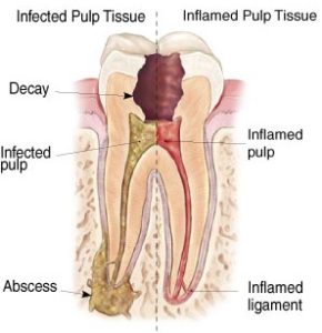 Root canal therapy in Hornsby