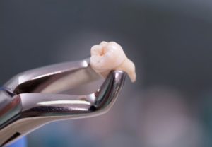 Tooth removal in Hornsby