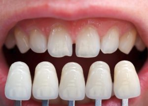 Dental veneers in Hornsby