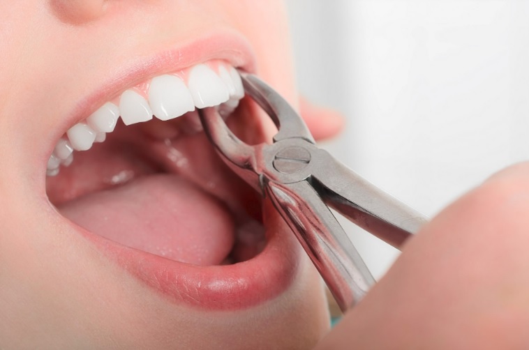 Tooth removal in Hornsby