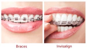 Invisalign vs Braces effectiveness